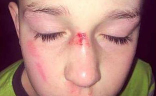Una madre desesperada denuncia en Facebook las consecuencias del acoso a su hijo con autismo